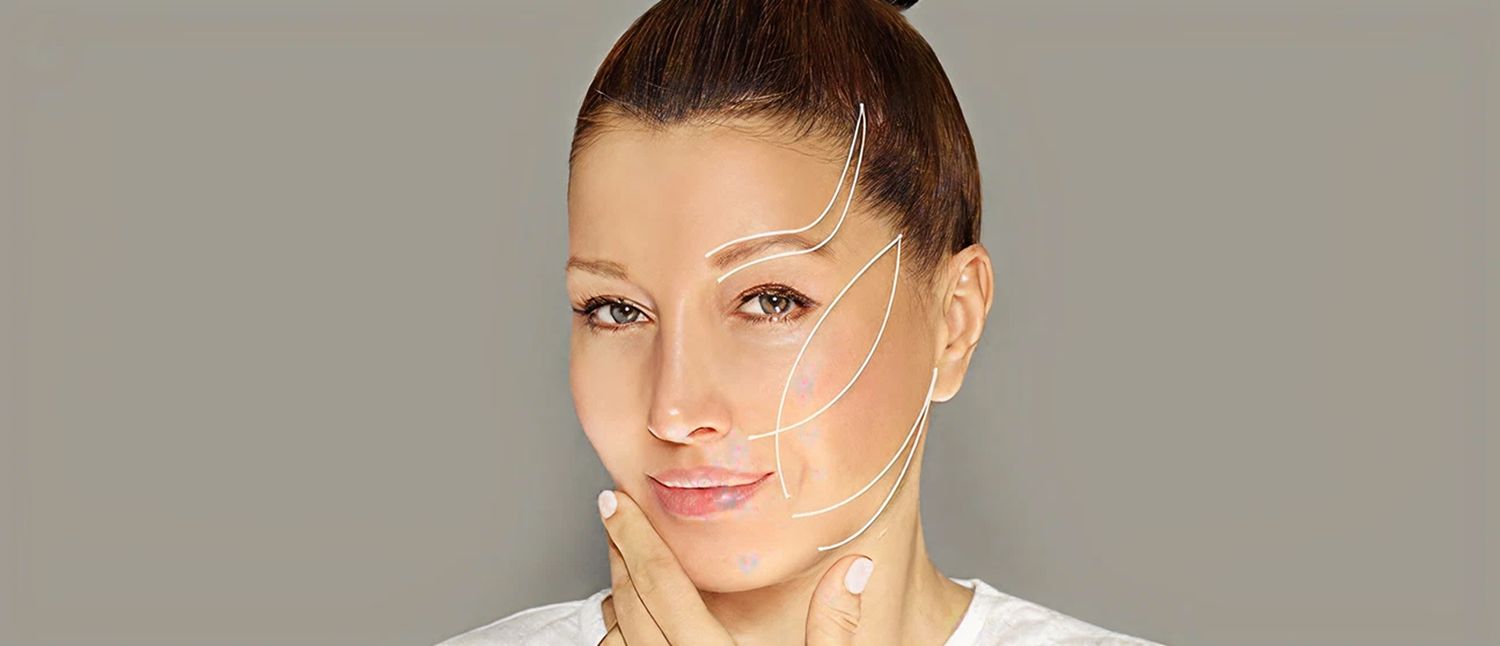 What Is the Recovery Time of PDO Threads Lift Near Me in Cleveland, OH